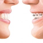 Alternatives to Braces 1.png