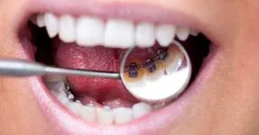 lingual braces for adult