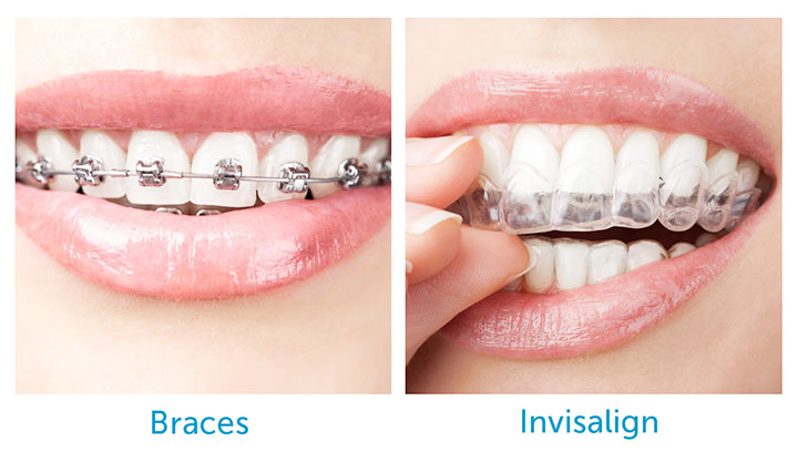 braces vs invisalign comparison