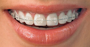 clear brace orthodontics
