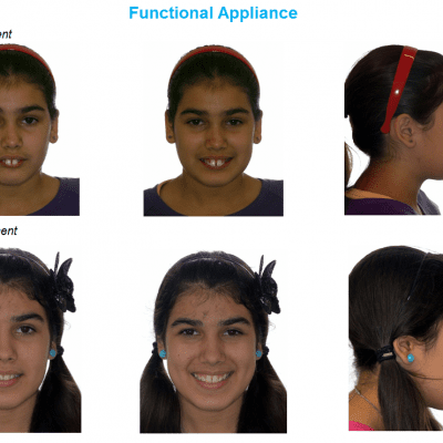 jaw correction functional appliance jaw surgery