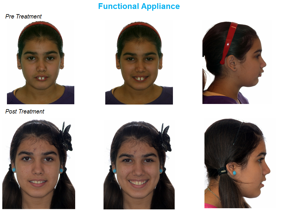 jaw correction functional appliance jaw surgery