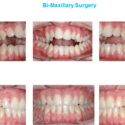 open bite correction improving your smile