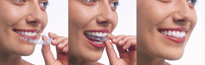 what is Invisalign