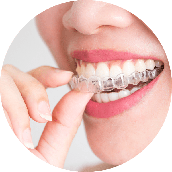 what is mo aligner