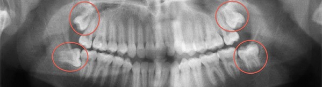 DO I NEED TO HAVE ALL MY WISDOM TEETH REMOVED?
