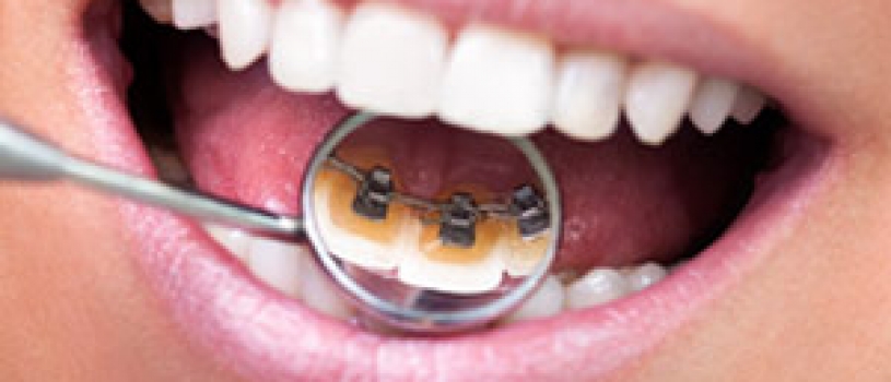 What are Lingual Braces ?